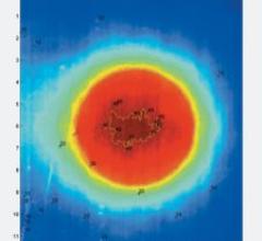 AccuBoost System Delivers Focused Radiation to Lumpectomy Cavity