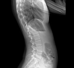 EOS Imaging Frost Sullivan Orthopedic Imaging X-Ray Systems Digital Radiography