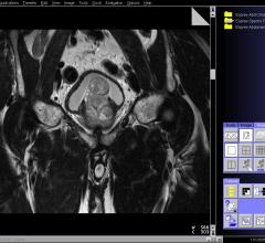 prostate cancer, novel intrinsic subtypes, study, ASTRO 2016