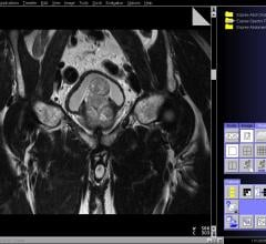 prostate cancer, SBRT, stereotactic body radiotherapy, ASTRO 2016 study, Robert Meier, control, side effects, toxicity