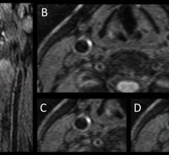 IPH, intraplaque hemorrhage, diabetic patients, stroke risk, 3-D MRI