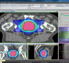 high-risk prostate cancer, radical local treatment, Umea University Sweden study, mortality