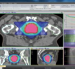 prostate cancer, hypofractionated radiationt therapy, accelerated RT, side effects, treatment time, ASTRO 2016, NRG Oncology/RTOG 0415