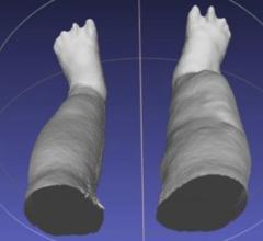 Portable 3-D Scanner Assesses Patients with Elephantiasis