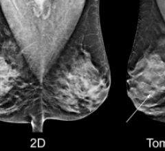 Hologic Total Breast Tomosynthesis Mammography Systems Women's Health