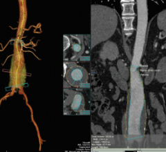 Vital Images VitreaAdvanced Enterprise Imaging Remote Viewing RSNA 2014