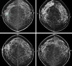 ACR Recommends More Aggressive Breast Cancer Screening for Higher-Than-Average-Risk Women