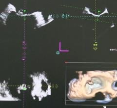 ASE Participating in Global Study to Establish New Standardization in Cardiovascular Ultrasound