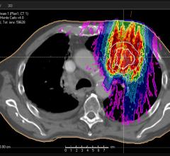 ASTRO Updates Guidelines for Palliative Lung Radiation Therapy