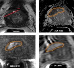 New Studies Highlight MRI Use for Prostate Cancer Screening and Management