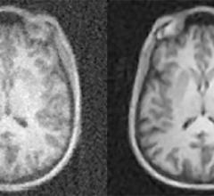 Artificial Intelligence Provides Faster, Clearer MRI Scans