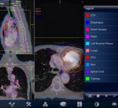 Accuray Rolls Out PlanTouch for the CyberKnife System