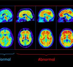 NIH, Alzheimer's, recommendations, Research Summit 2015