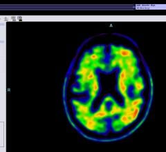 Data Demonstrates F-18 Flutemetamol PET Indicates Progression From Amnestic Mild Cognitive Impairment to Alzheimer’s