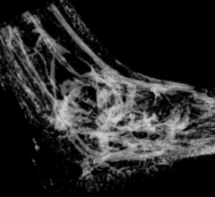 critical limb ischemia, amputations, MRI-based mapping, CLI, British Heart Foundation