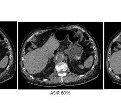 he latest version of ASiR is being positioned for its ability to significantly reduce patient radiation dose during CT exams while achieving a reconstruction speed similar to that of conventional analytical reconstruction using filtered back projection. 