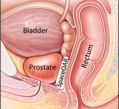 New Prostate Cancer Radiotherapy Technique Aims to Preserve Sexual Function