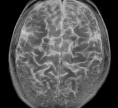 Brain MRI