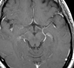 MRI, brain damage, heart disease protein, NT-proBNP, Radiology journal