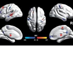 autism, fMRI, University of Warwick, voxels, BWAS