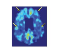 PET, damaged brain, remapping, Riken, AIST, motor function