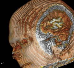 Brain, MRI