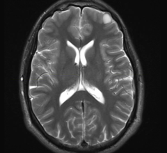 whole brain radiotherapy, WBRT, metastatic lung cancer, The Lancet study, supportive care