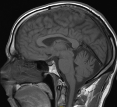 ISMRM Issues Guidelines for MRI Gadolinium Contrast Agents