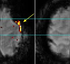 7T MRI Provides Precise 3-D Maps of Brain Activity