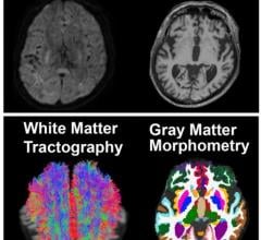 Machine Learning IDs Markers to Help Predict Alzheimer's