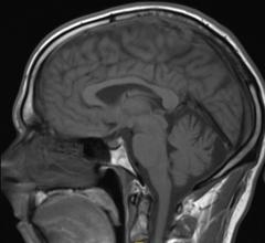 molecular MRI, contrast agents, PSMA, cancer, SNMMI, Sangeeta Ray