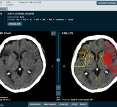 Brainomix Secures $9.8m Investment to Tackle Strokes With AI