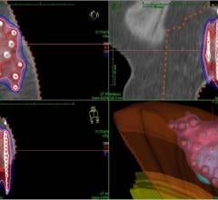 Breast brachytherapy, partial breast irratiation