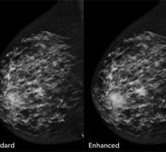 FDA Issues Proposed Order to Reclassify Certain Radiological Medical Image Analyzers