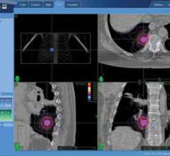 A 3-D, axial, sagittal and coronal view of the treated areahighlighted in pink, as well as radiation dose shown in multicoloredisodose lines.