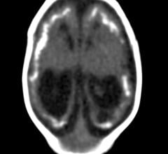 Smoking and Diabetes Linked to Brain Calcifications