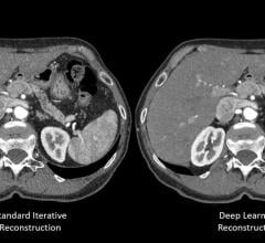 Canon Medical Introduces Deep Learning-Based CT Image Reconstruction