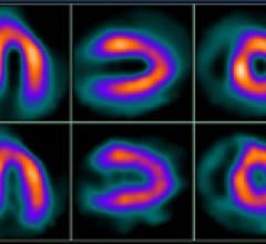 Cardiac Hybrid Imaging an Effective Tool for Predicting Heart Attacks