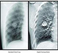 Carestream’s X-ray digital tomosynthesis functionality creates three-dimensional datasets from digital radiography (DR) that can be scrolled through similar to computed tomography (CT) imaging. It received 510(k) clearance from the U.S. Food and Drug Administration (FDA) in January 2020. Digital tomosynthesis uses a single sweep of X-ray exposures and streamlines operator workflow by separating the process of DT exposure acquisition from image volume formation. 