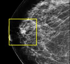 Hologic Showcases 3-D Mammography, Advanced Imaging Technologies at RSNA 2012