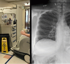 #COVID19 #Coronavirus #2019nCoV #Wuhanvirus #SARScov2 Chest radiography through glass. Technologists position the portable x-ray unit outside the patient room, with the tube peering through the wire-reinforced isolation room window (A). AP chest x-ray through obtained is of diagnostic quality (B).