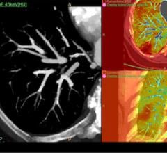 IQon, Spectral CT, dual energy CT