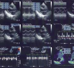 brachytherapy systems prostate technology treatment planning civco ex3 stepper