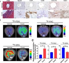 PET Imaging Offers New Possibilities in Chronic Liver Disease Management