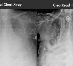 rsna 2013 advanced visualization DR CR systems clearread riverain