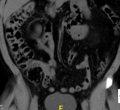 colon, colonoscopy