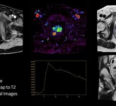 MRI