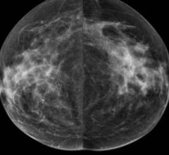 Densitas Receives FDA Clearance for PACS-Centric Breast Density Software