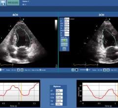 DiA Imaging Analysis Partners With GE Healthcare on Automatic Imaging Analysis Tools