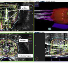 Shorter Radiotherapy Courses Safe and Effective for Prostate Cancer